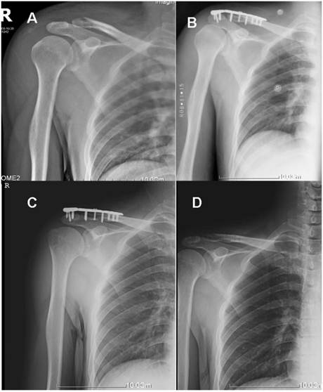 Surgical Treatment for Unstable Distal Clavicle Fracture with