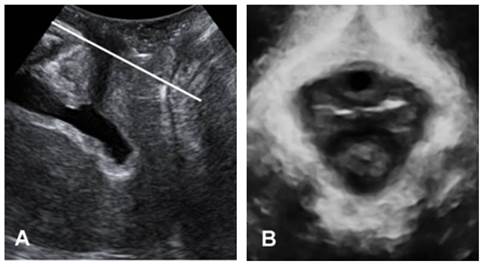 Three-dimensional Ultrasound Appearance of Pelvic Floor in Nulliparous