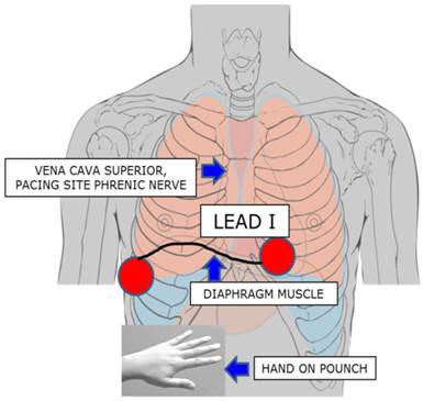 ECG-Guided Surveillance Technique in Cryoballoon Ablation for