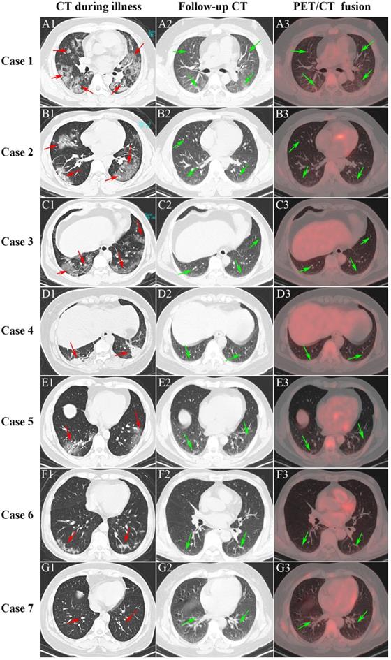 Use of total-body PET imaging to identify deep-tissue SARS-CoV-2