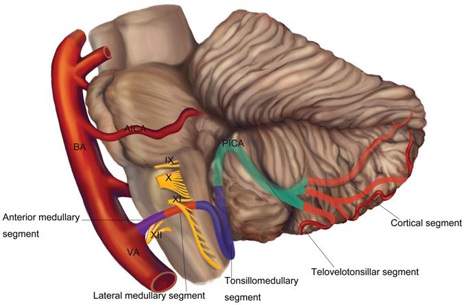 posterior inferior cerebellar artery stroke