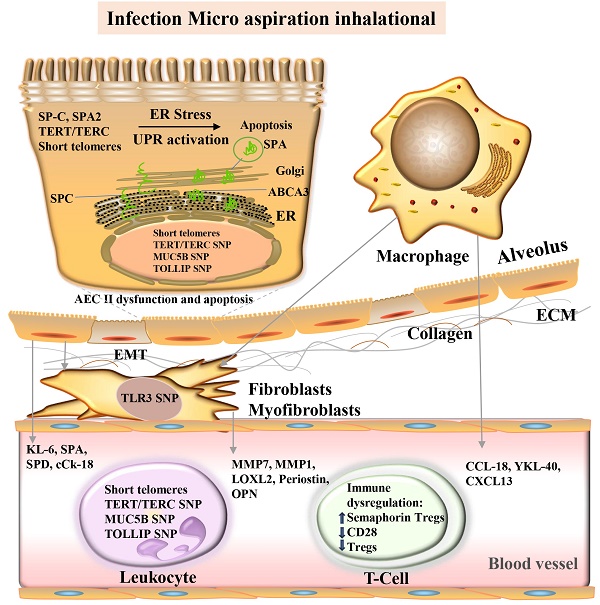 idiopathic pulmonary fibrosis pathogenesis